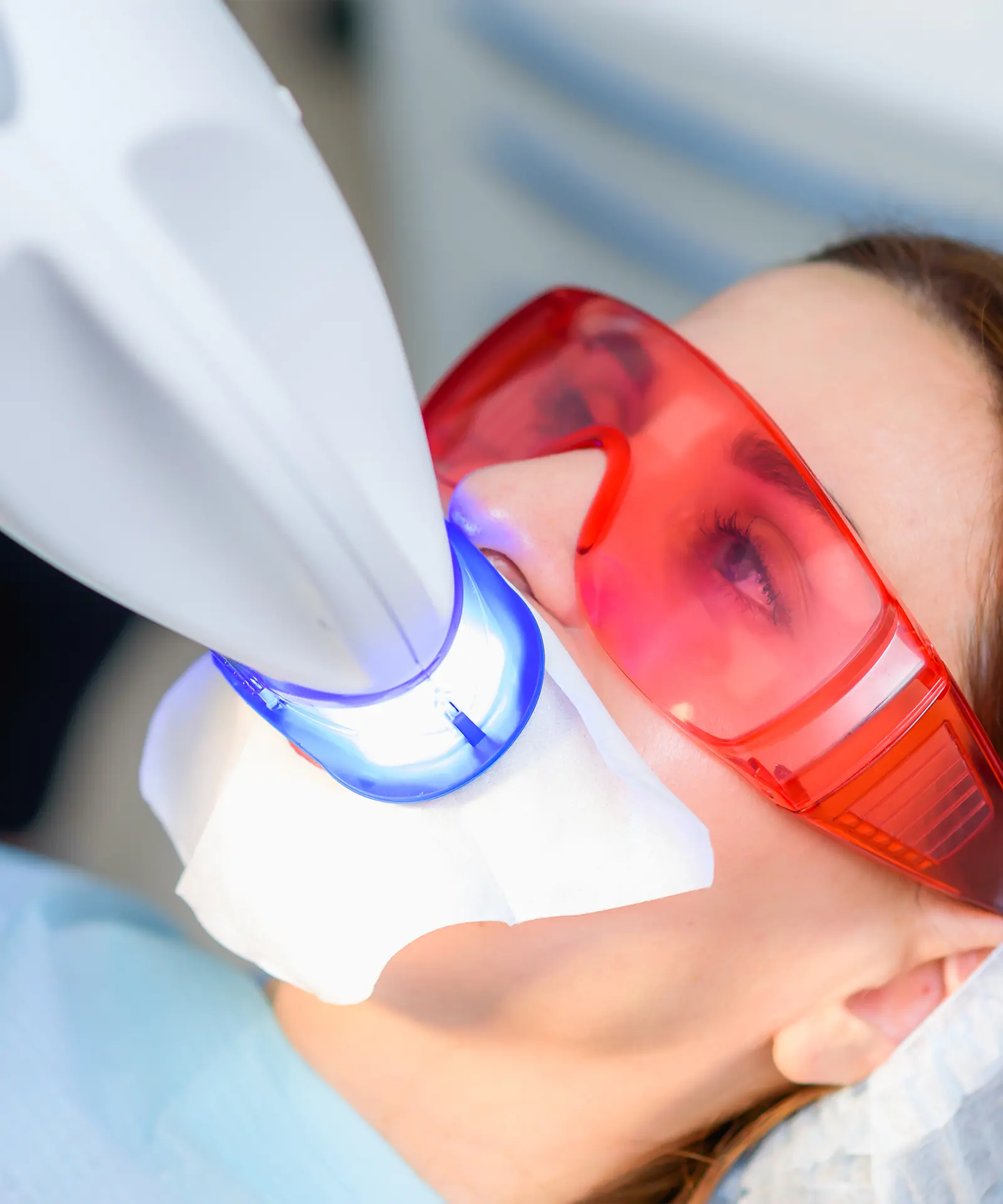 Dental Beyazlatma – Bleaching