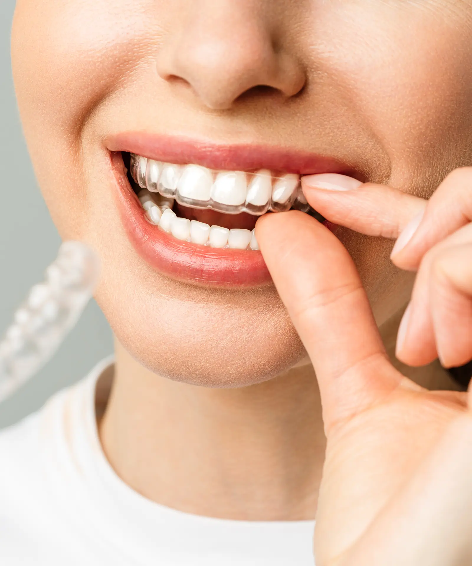 Şeffaf Plak Invisalign